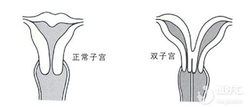 注意！子宫畸形正危及你的 “好孕”?！